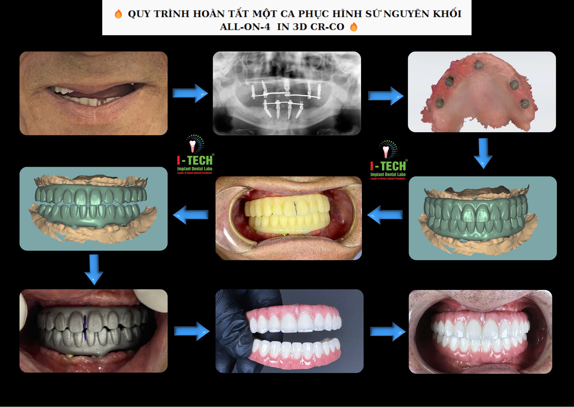 QUY TRÌNH HOÀN TẤT MỘT CA PHỤC HÌNH SỨ NGUYÊN KHỐI ALL-ON-4 IN 3D CR-CO TẠI I-TECH LAB